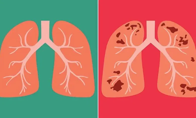 The increasing number of TB patients in Uttarakhand has become a cause of concern for the health department