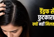 Dandruff Treatment: Is your dandruff constantly returning? Find out which mistakes are aggravating your scalp problem.