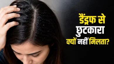 Dandruff Treatment: Is your dandruff constantly returning? Find out which mistakes are aggravating your scalp problem.