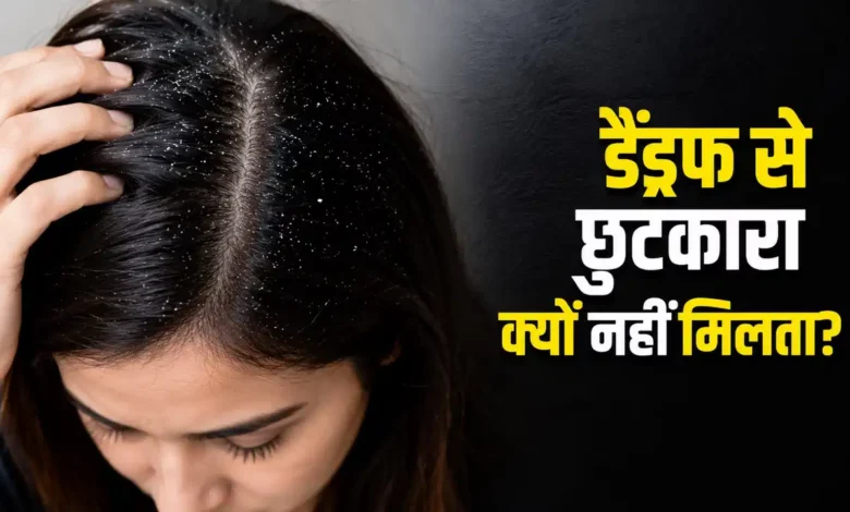 Dandruff Treatment: Is your dandruff constantly returning? Find out which mistakes are aggravating your scalp problem.