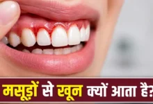 Gum Disease: Bleeding gums could be a sign of a serious condition! Find out when you should see a doctor immediately.